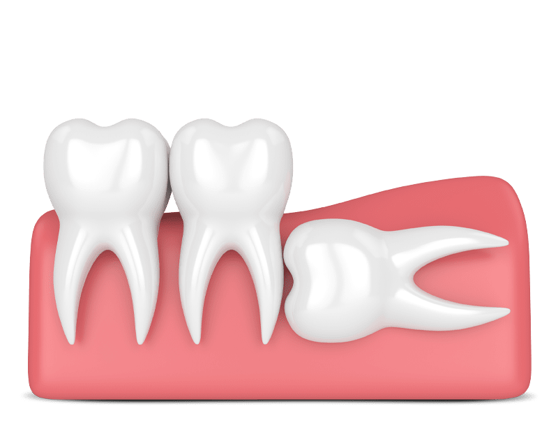 دندان نهفته درلثه چقدر خطرناک است؟