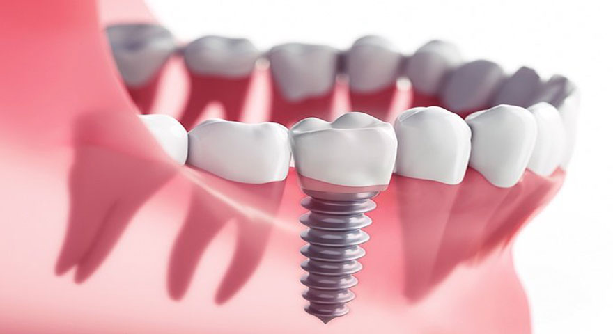 ایمپلنت دندان دقیقا چیست؟!